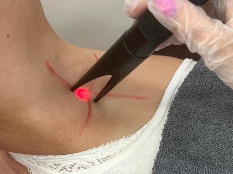 Hair removal laser