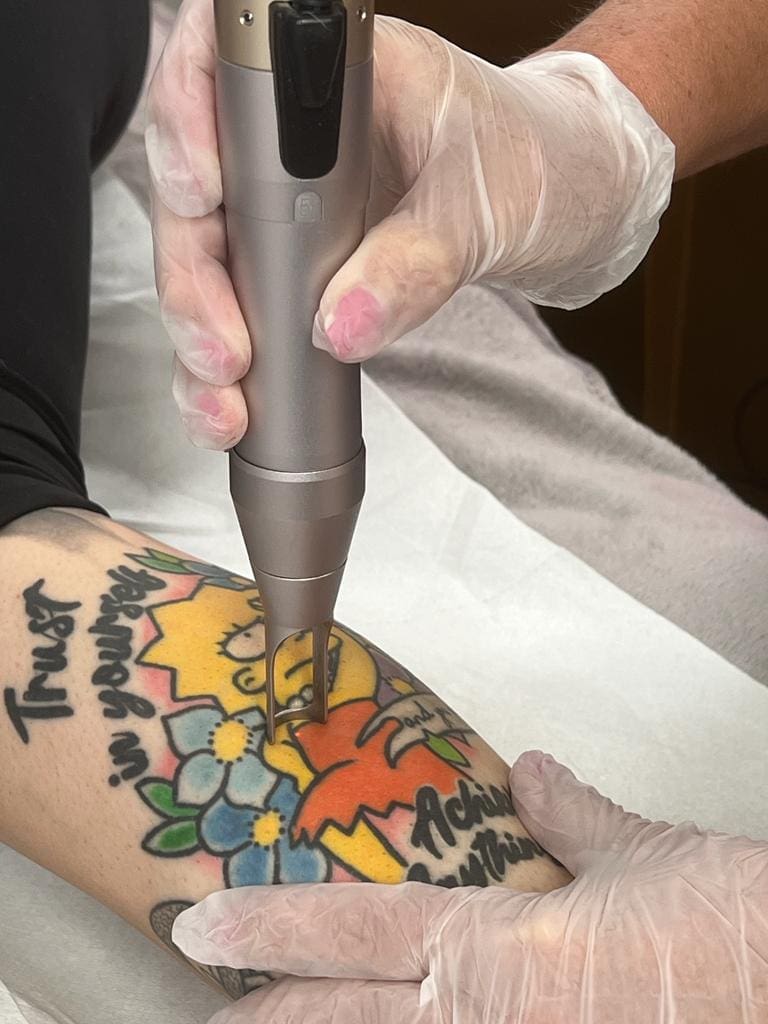 Skin Treatment tattoo removal laser in action
