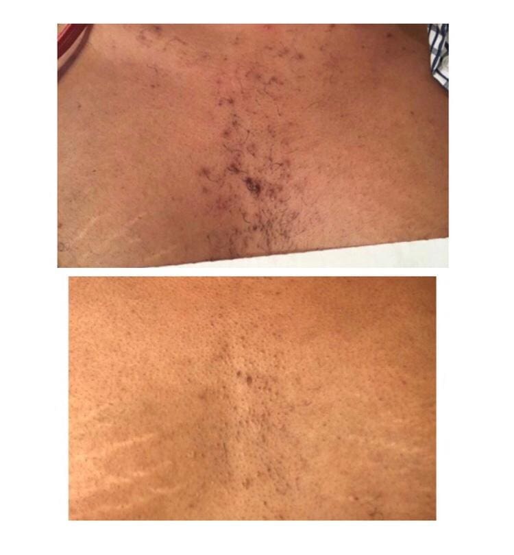 Hair removal by The Polaris 1064 Long Pulsed ND YAG Hair Removal Laser