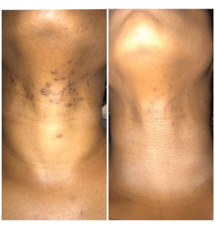 Hair removal by The Polaris 1064 Long Pulsed ND YAG Hair Removal Laser