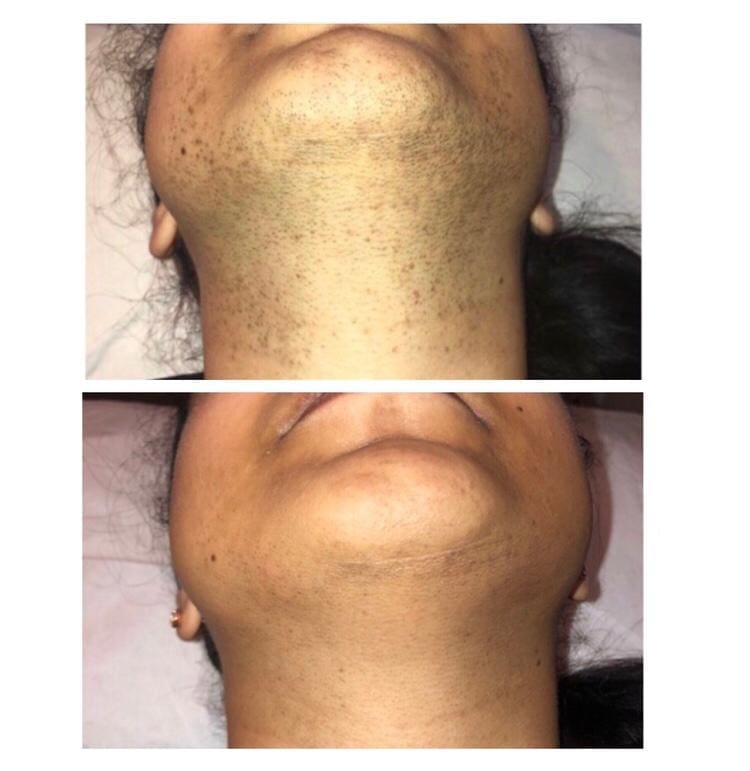 Hair removal by The Polaris 1064 Long Pulsed ND YAG Hair Removal Laser